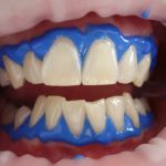 Things To Know Before Doing A Laser Teeth Whitening Procedure.