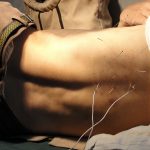 Traditional Chinese Medicine: An Introduction To Acupuncture
